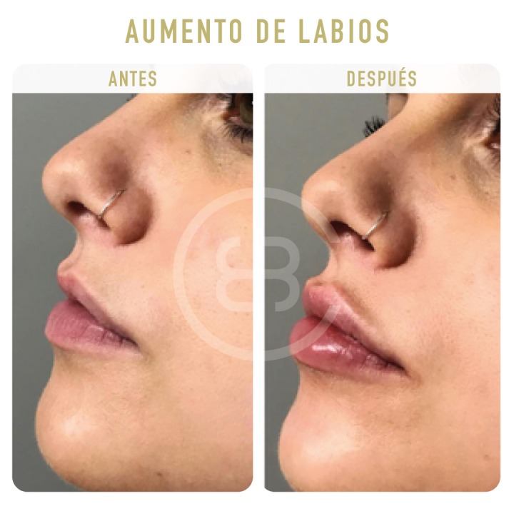 Antes / después Aumento de labios