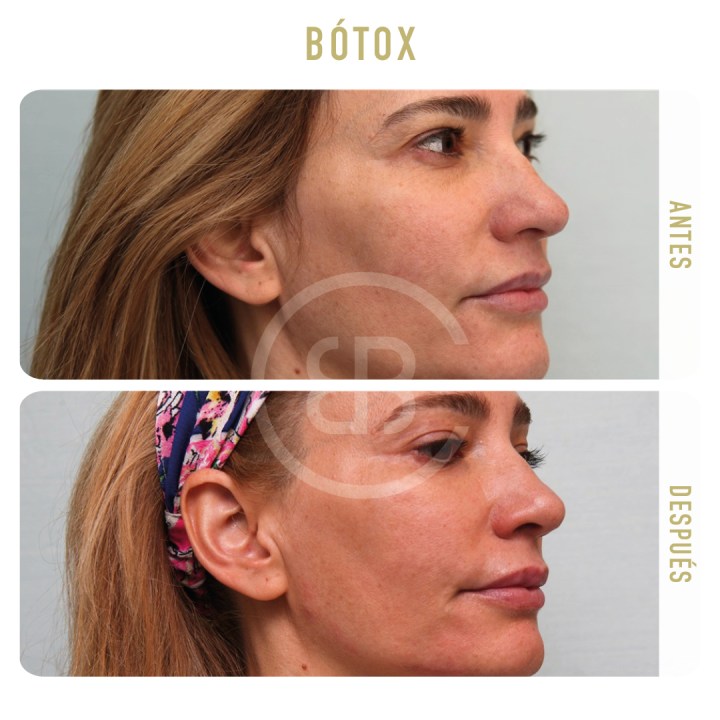 Antes / después Botox